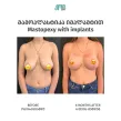 სარძევე ჯირკვლის (ძუძუს) პლასტიკური ქირურგიის თანამედროვე შესაძლებლობები